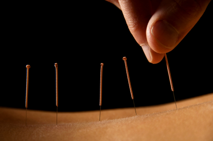 A close-up image of a hand placing acupuncture needles into the skin on a person's back.