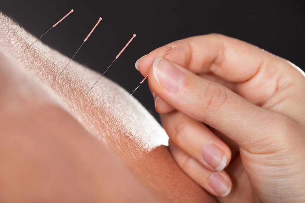 Acupuncture on the back